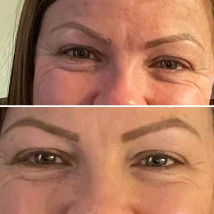 Before and after comparison of a patient's face showing reduced under-eye hollowness and improved skin texture